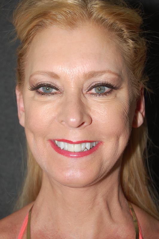 patient after Blepharoplasty (Eyelid Surgery) treatment