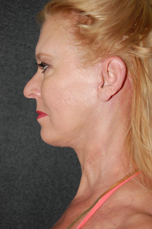 patient after Blepharoplasty (Eyelid Surgery) treatment