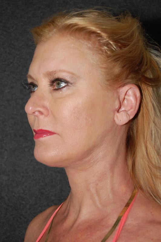patient after Blepharoplasty (Eyelid Surgery) treatment