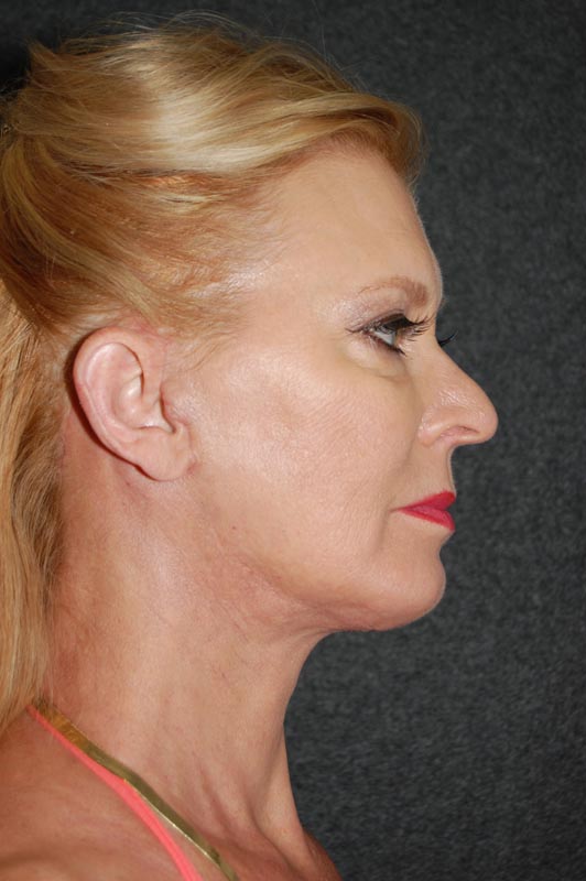 patient after Blepharoplasty (Eyelid Surgery) treatment