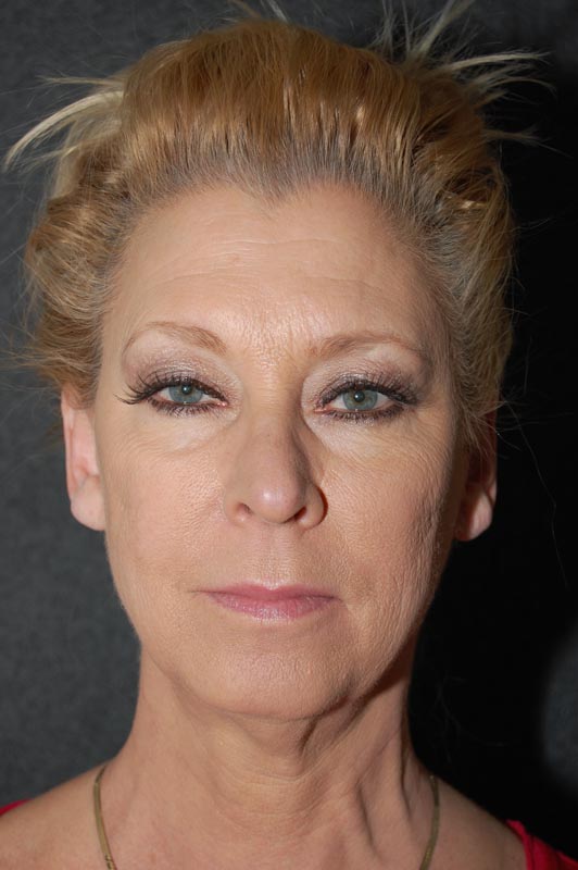 patient before Blepharoplasty (Eyelid Surgery) treatment