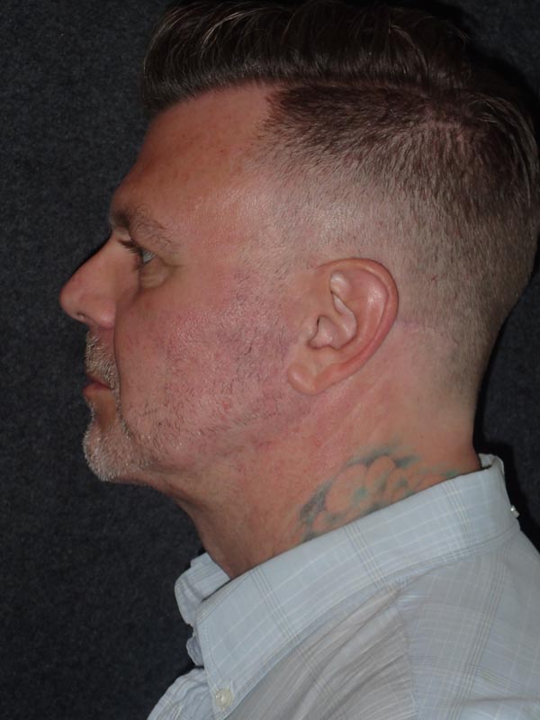 patient after Cervicoplasty (Neck Lift) treatment