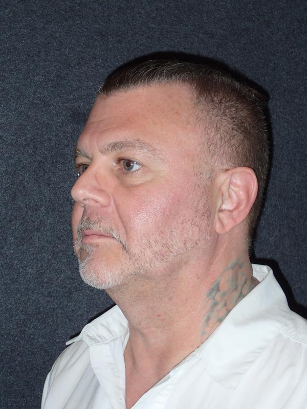 patient before Cervicoplasty (Neck Lift) treatment