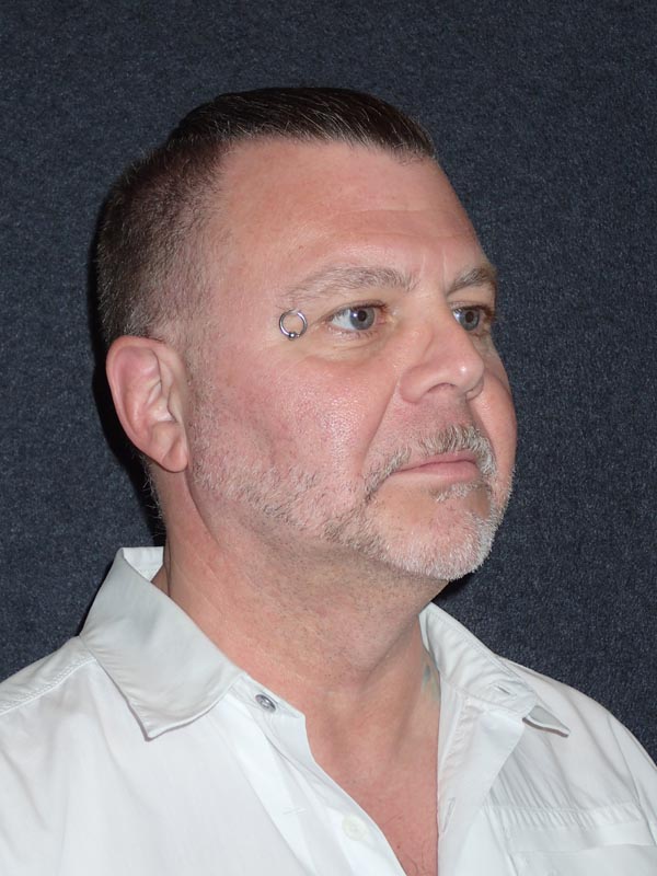 patient before Cervicoplasty (Neck Lift) treatment