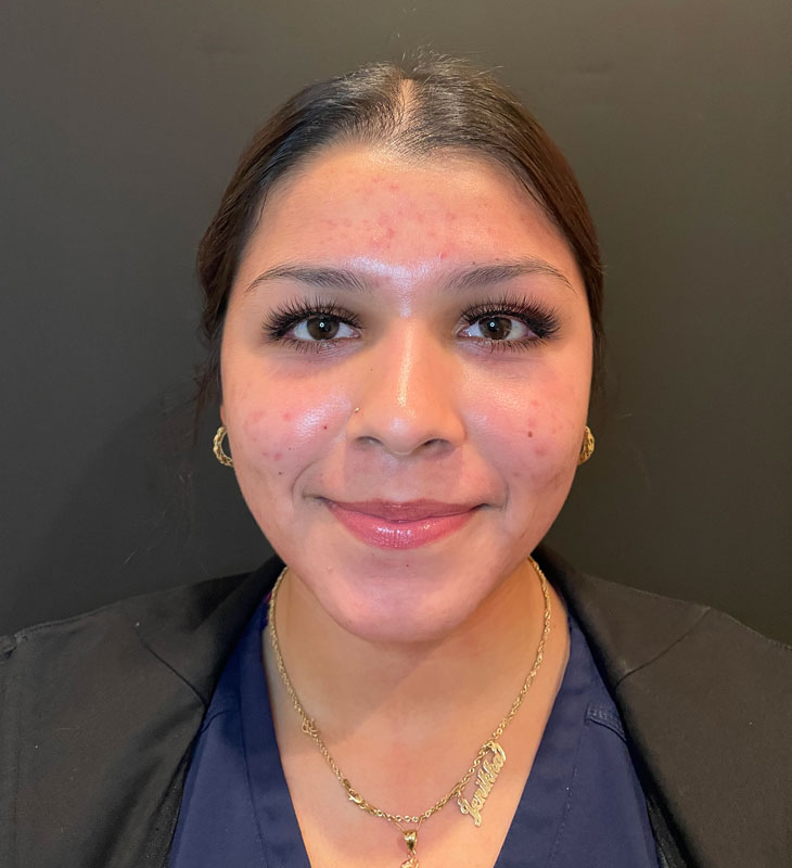 patient after Face Reality Acne Treatment