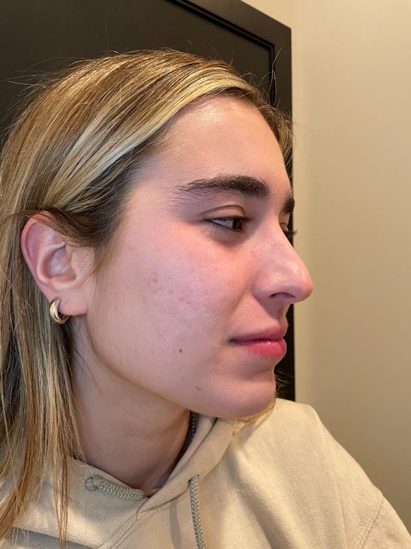 patient after Face Reality Acne Treatment