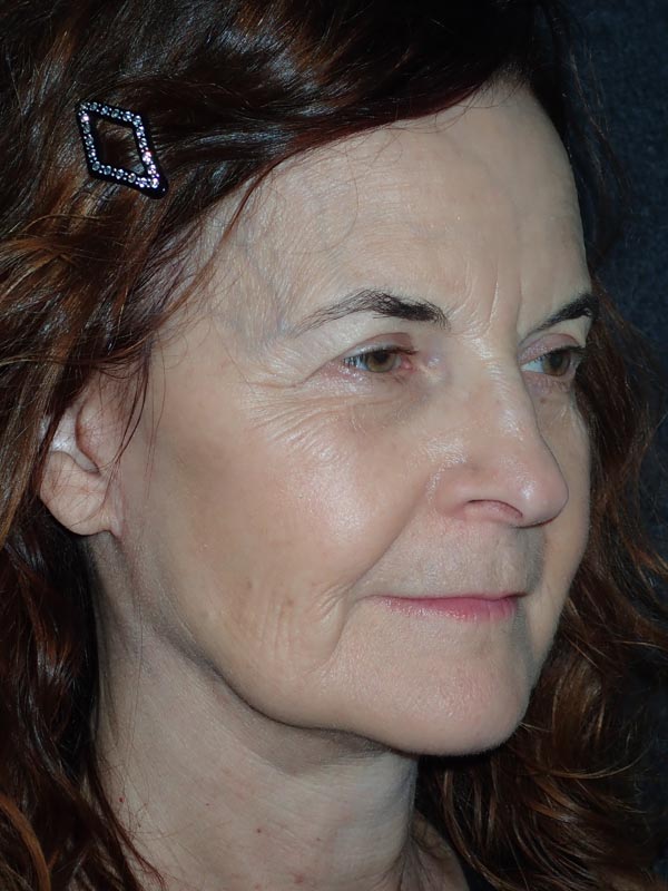 patient after Facelift with Buccal Fat Reduction