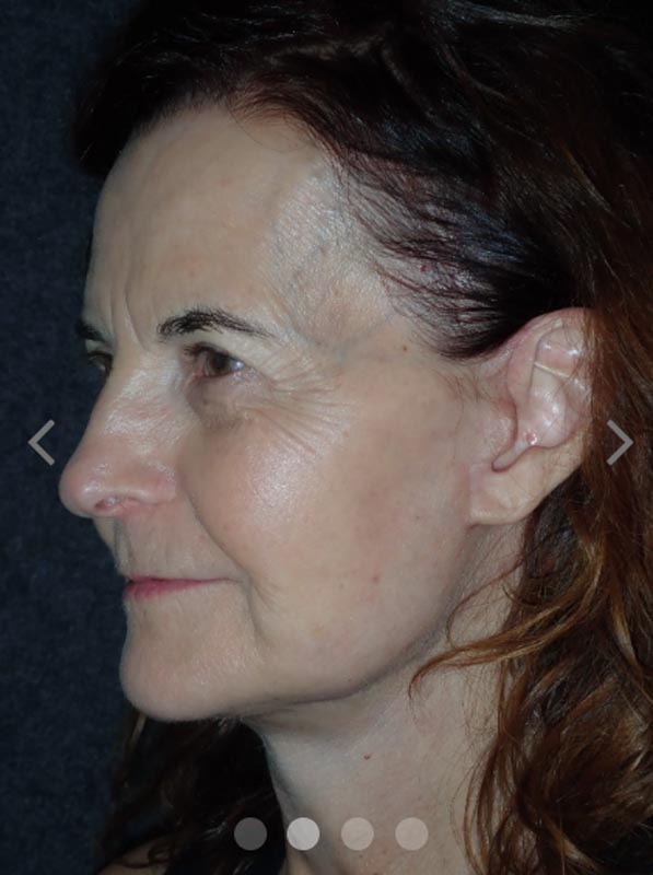 patient after Facelift with Buccal Fat Reduction
