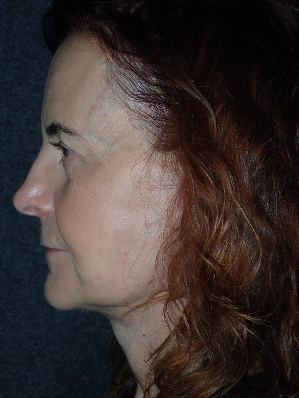 patient after Facelift with Buccal Fat Reduction