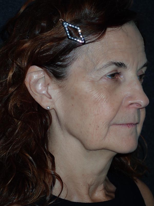 patient before Facelift with Buccal Fat Reduction