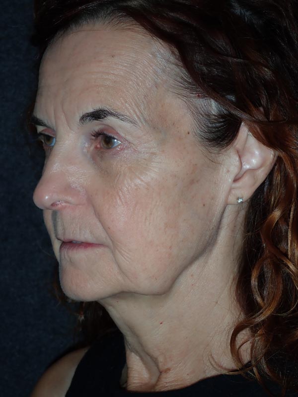 patient before Facelift with Buccal Fat Reduction