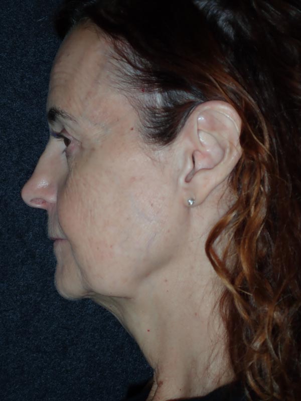 patient before Facelift with Buccal Fat Reduction
