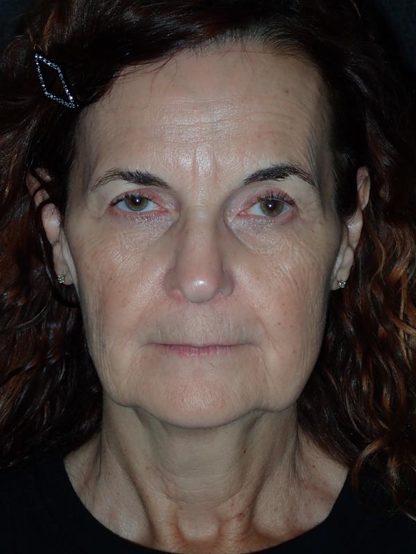 patient before Facelift with Buccal Fat Reduction