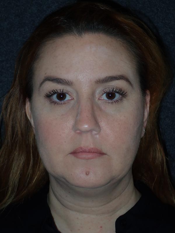 patient before Submental Liposuction & Chin Implant