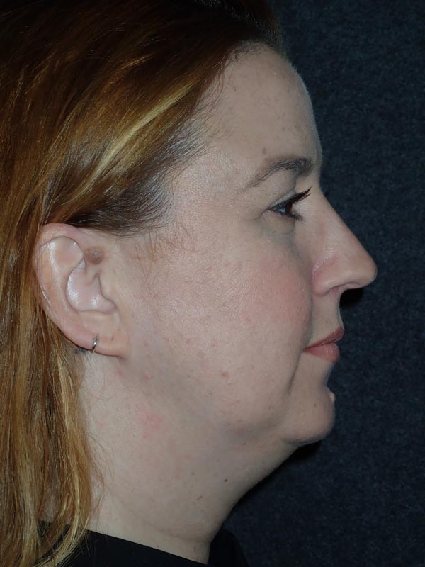 patient before Submental Liposuction & Chin Implant