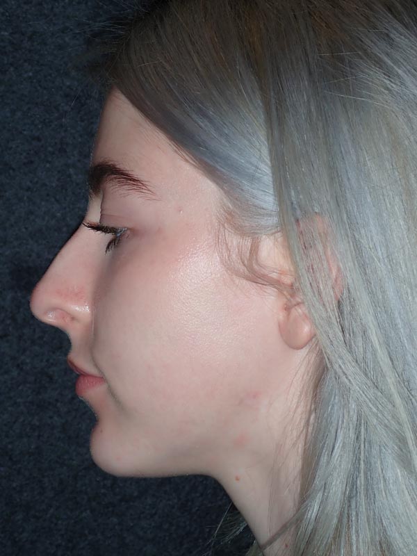 patient after Oral Surgery procedures