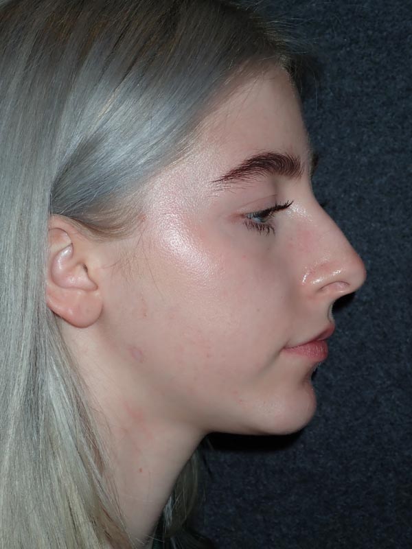 patient after Oral Surgery procedures