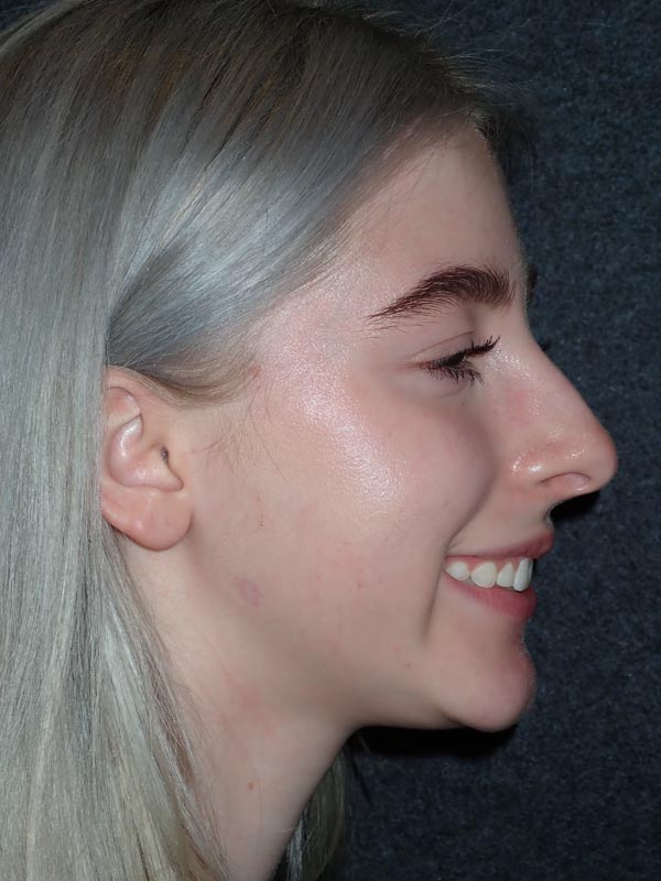 patient after Oral Surgery procedures