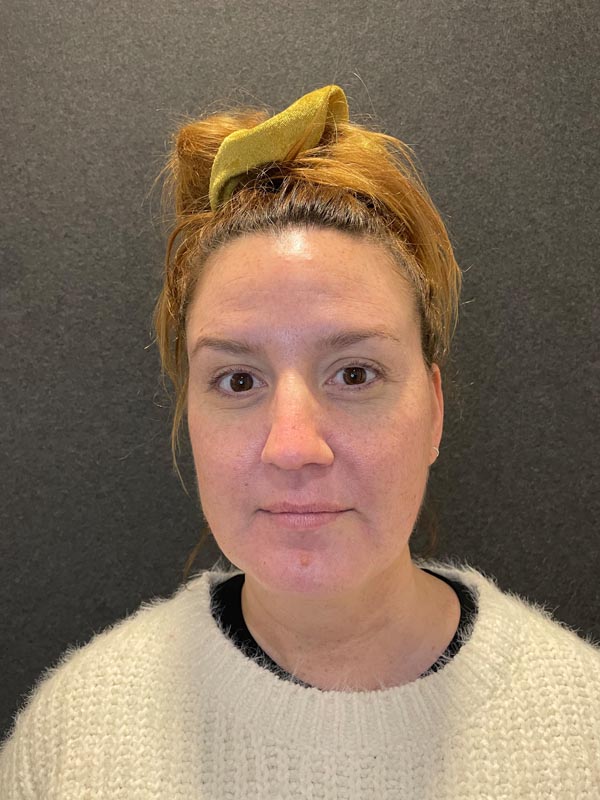 patient after Submental Liposuction & Chin Implant