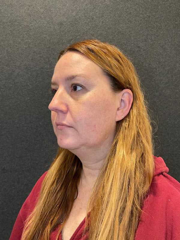 patient before Submental Liposuction & Chin Implant